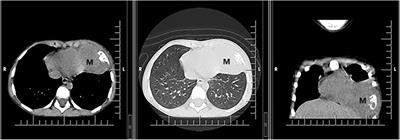 Difficulties in the management of an Askin tumor in a pediatric patient with cystic fibrosis: case report and literature review